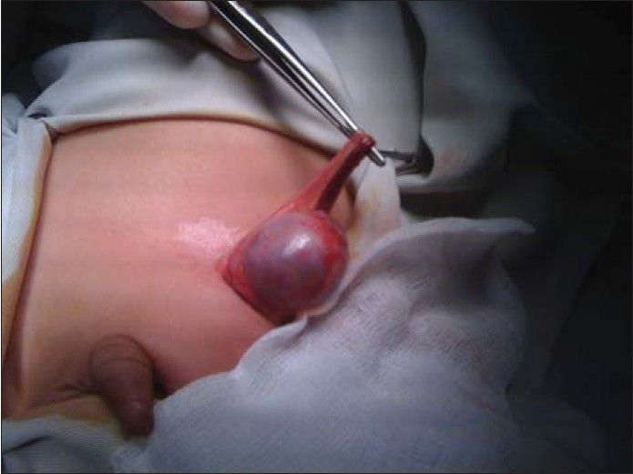 scrotal orchiectomy