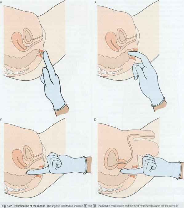 rigid proctoscopy procedure