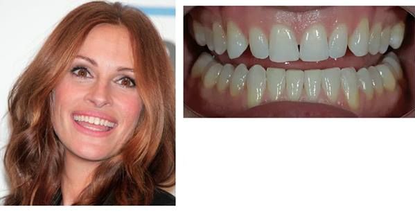 julia roberts big teeth