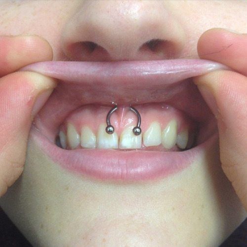smiley piercing with braces tumblr