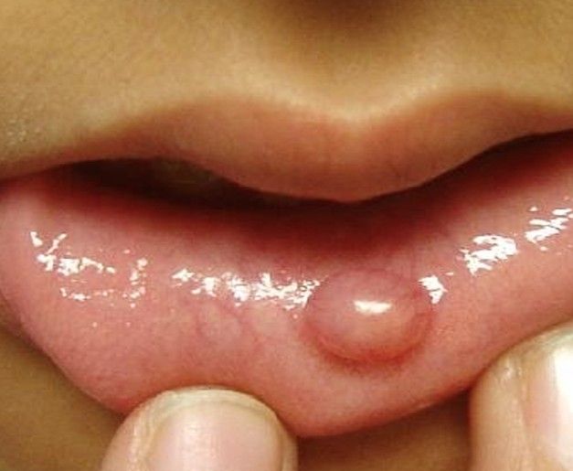 swollen vaginal lips