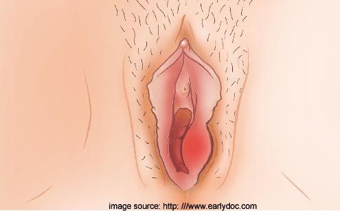 vaginal lips swollen from sex
