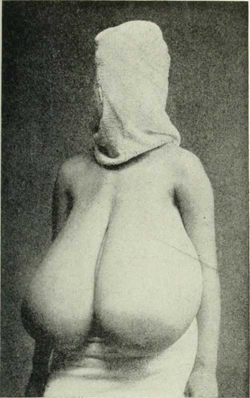 juvenile breast hypertrophy