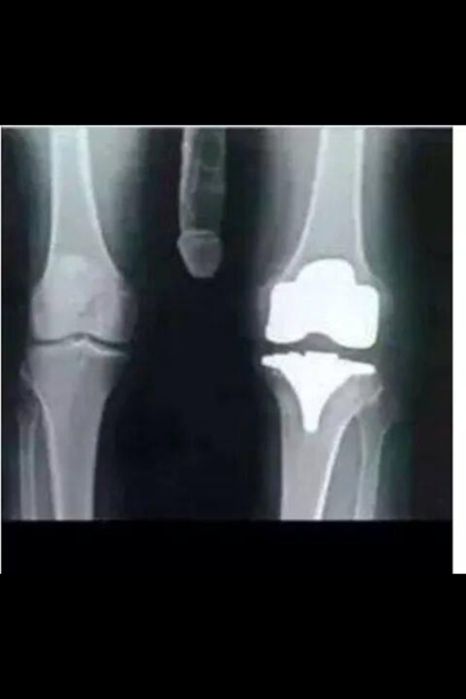 funny knee x ray