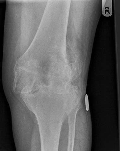 knee pain x rays