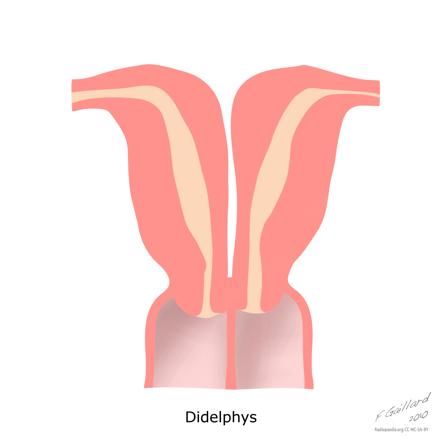 double  horned uterus