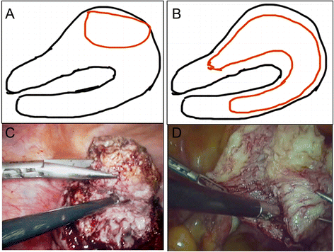 types of uterus surgery