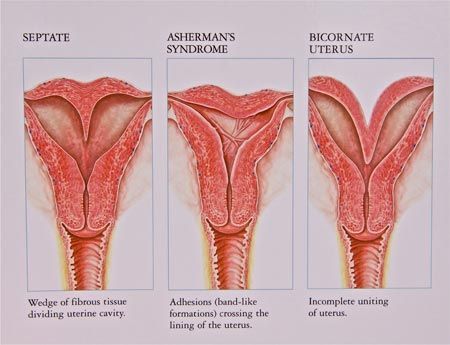septate uterus symptoms