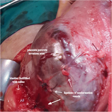 heart shaped uterus surgery