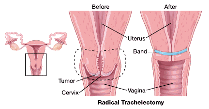 split uterus surgery