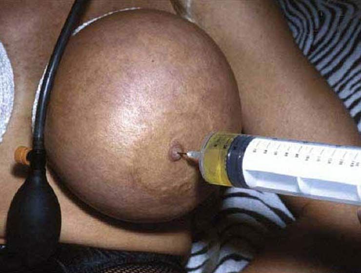 extreme breast modification