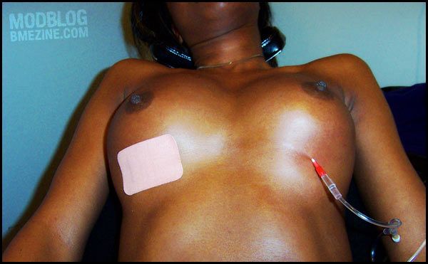 saline injections into the nipple