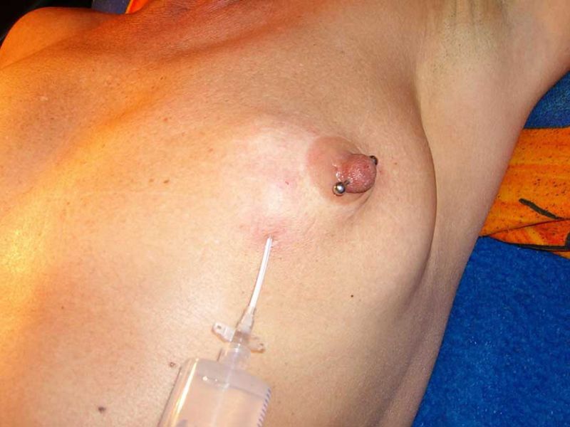 transgender breast saline infusion