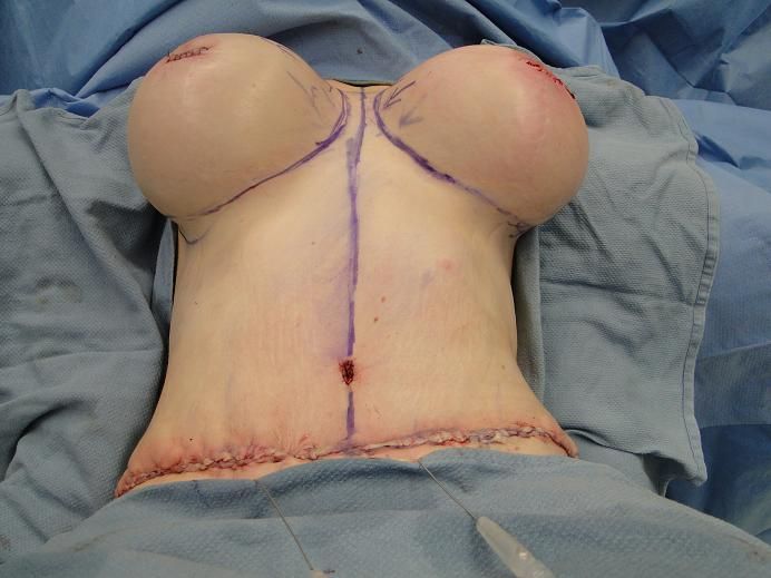 overfilled saline breast implants