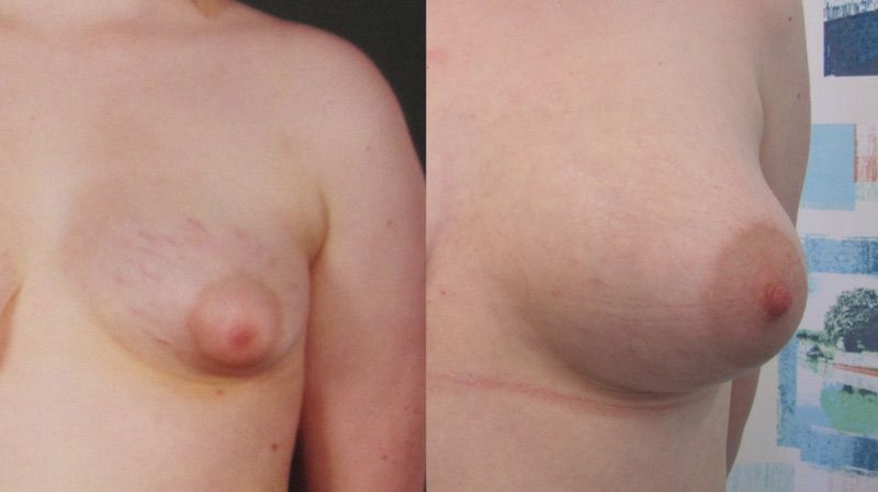 extreme breast augmentation implants