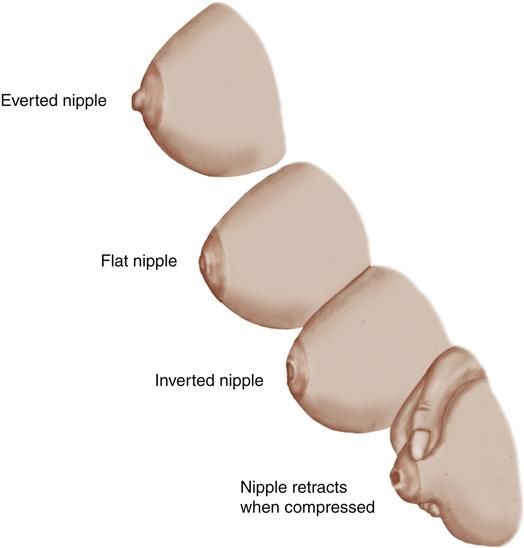 female nipple types chart