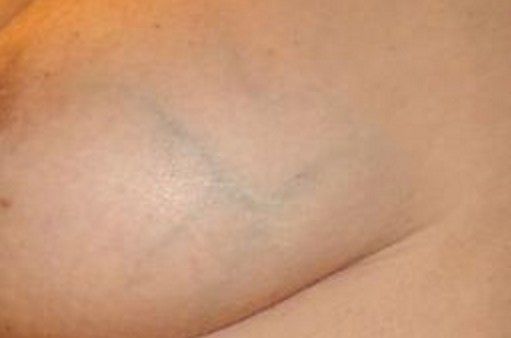 big blue veins on breast