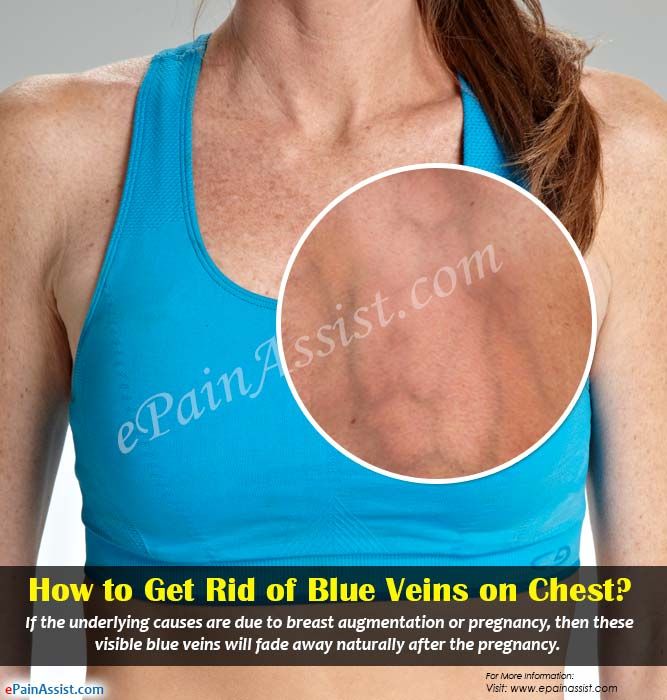 huge breast veins