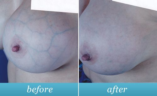 visible blue veins in breast