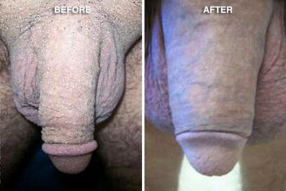 silicone injected penis massive