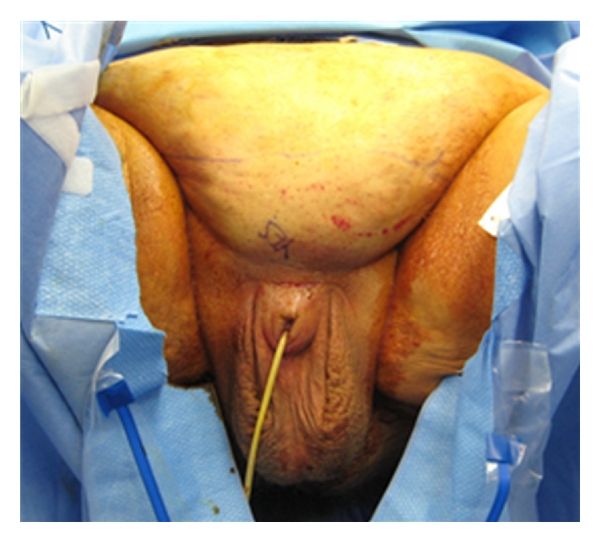 penile enlargement implants