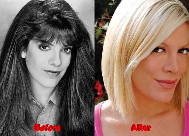 tori spelling before and after surgery