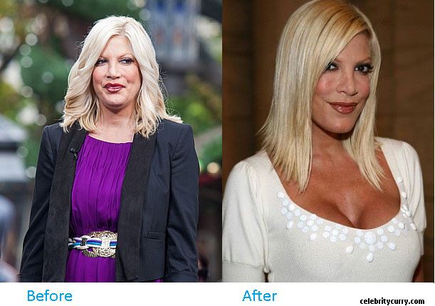 kim kardashian plastic surgery before after