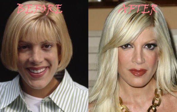 cher plastic surgery before and after