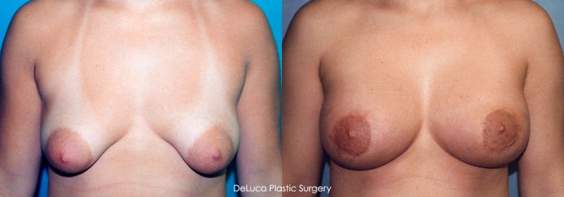 tubular puffy breasts