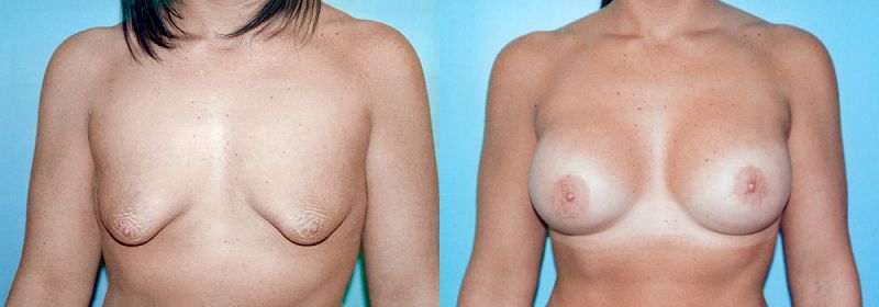 tubular breast correction