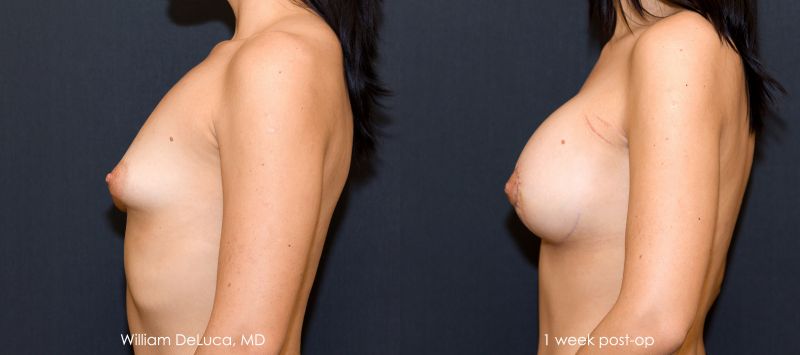 tuberous breast deformity