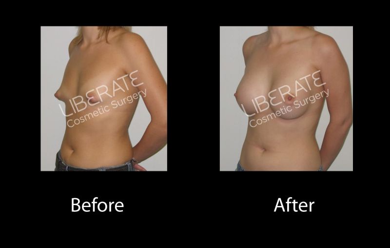 hypoplastic tubular breast before and after