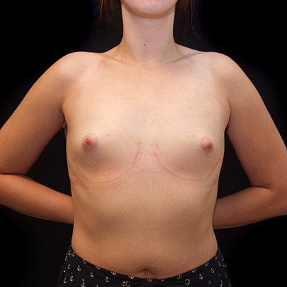 tubular breast surgery