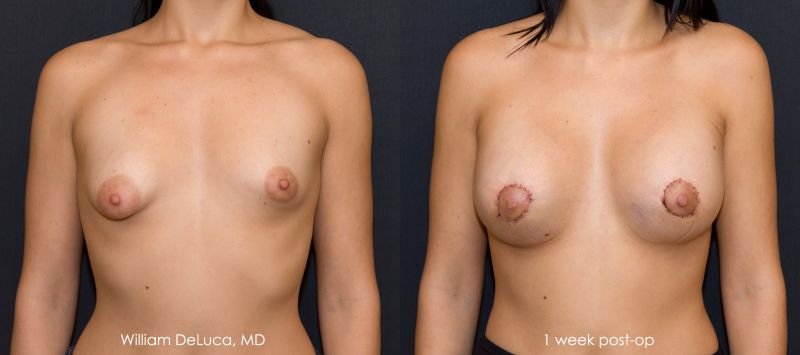 tubular breast augmentation before and after