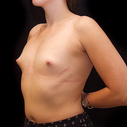 breast correction