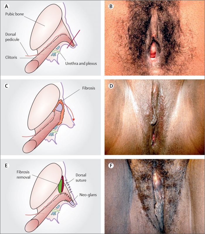 graphic genital mutilation