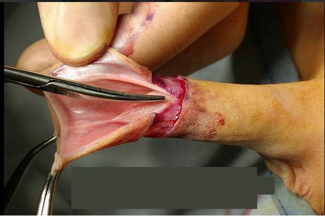 circumcised vagina