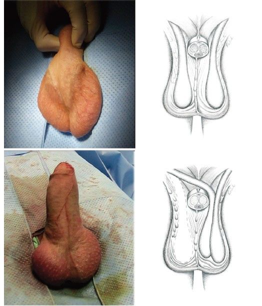no scrotum