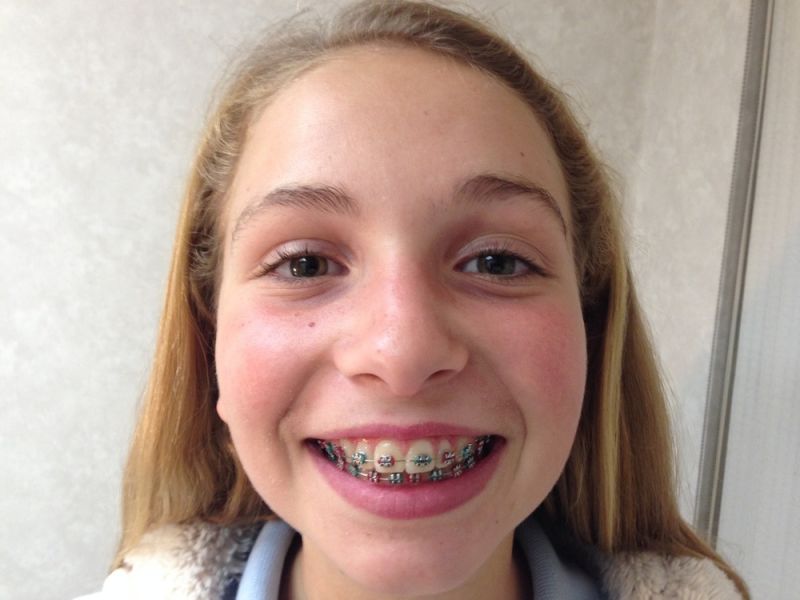 teenage girl braces