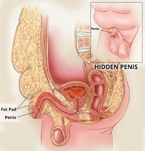 penis enlargement before and after