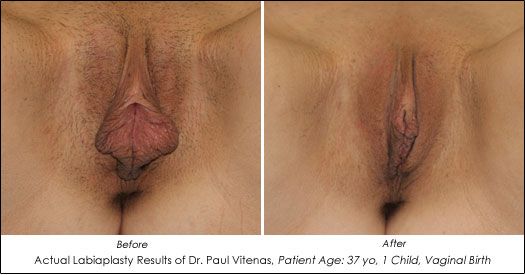 circumcised pussy before and after
