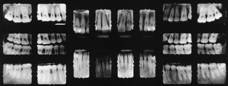 digital dental full mouth x rays