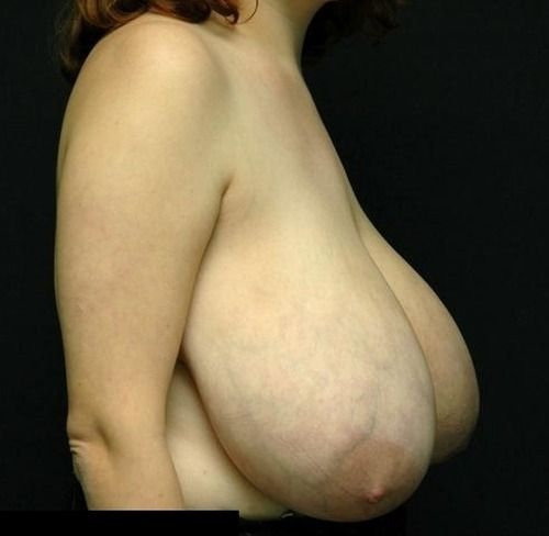 breast implants