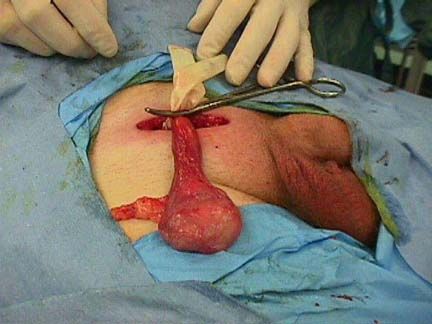 orchiectomy surgery procedure