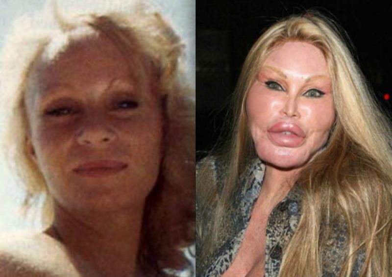 before botox and after mouth