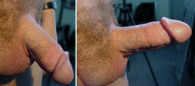 normal circumcised penis