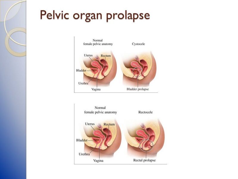 stages of pelvic organ prolapse