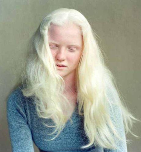 half albino girl