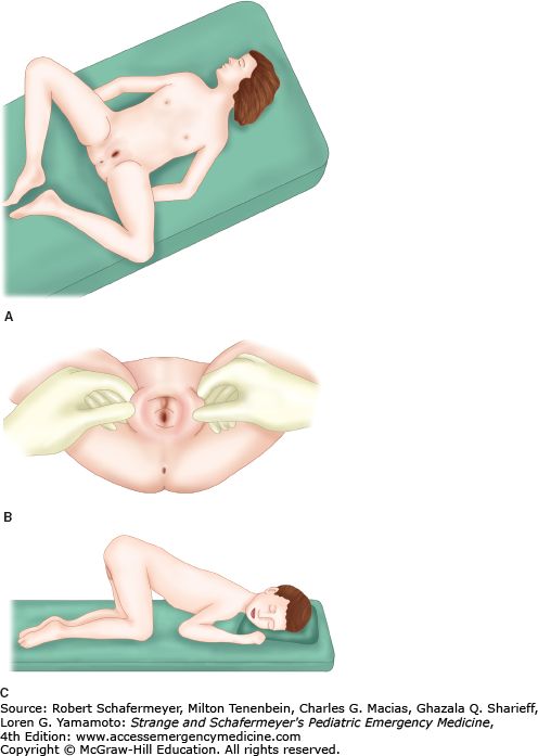 lithotomy position