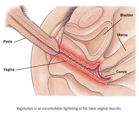Cervix Penetration By Penis.
